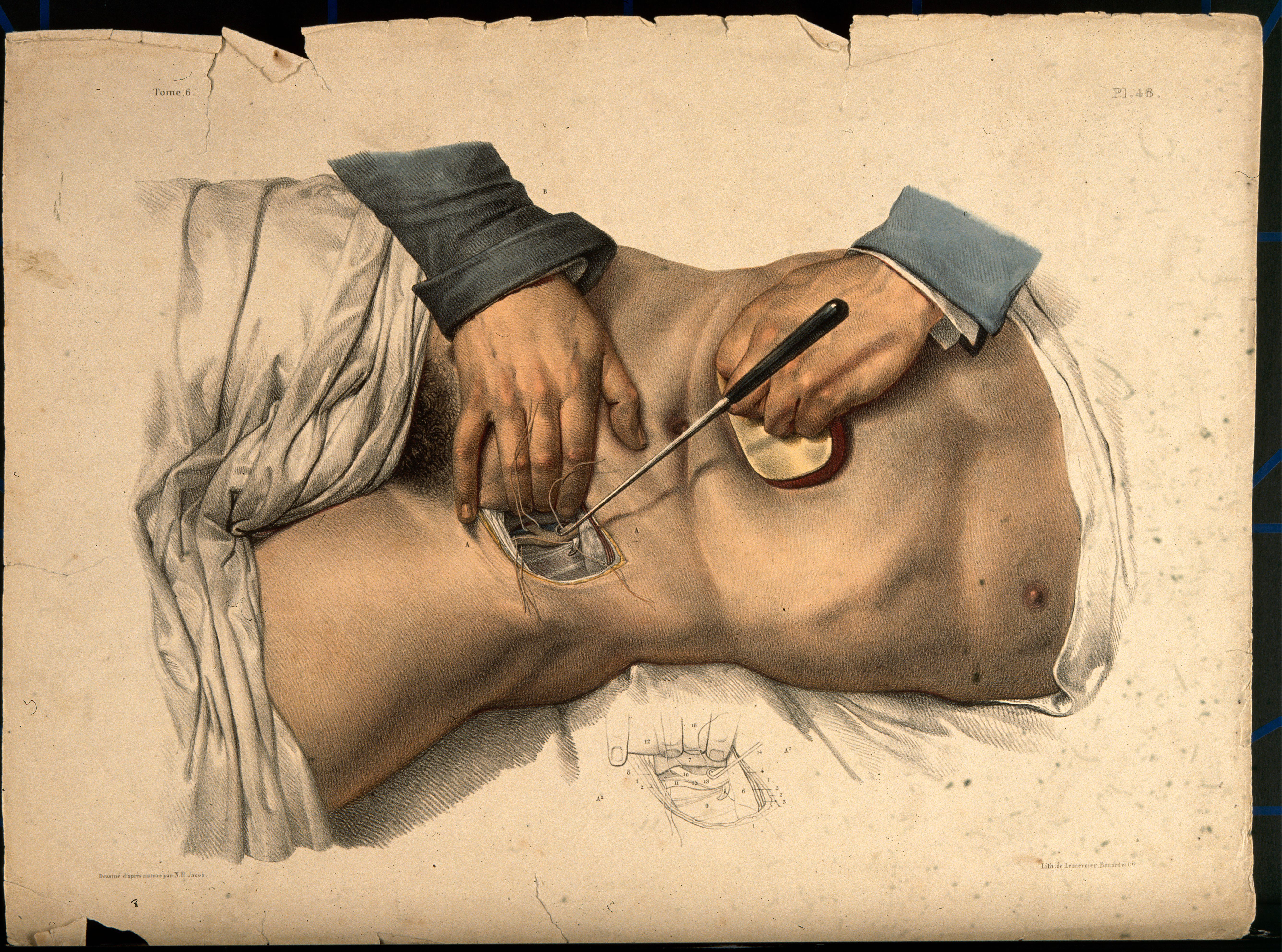 A drawing of a torso being operated